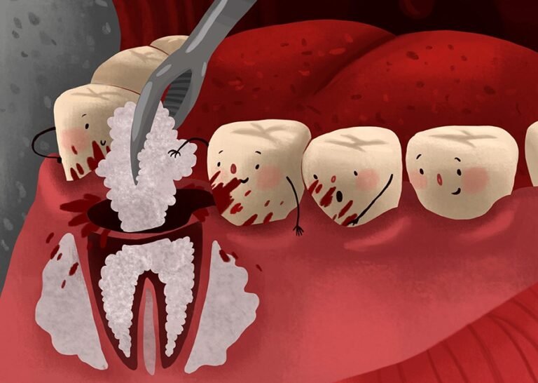 How Long Does A Bone Graft Take To Heal The Odyssey News