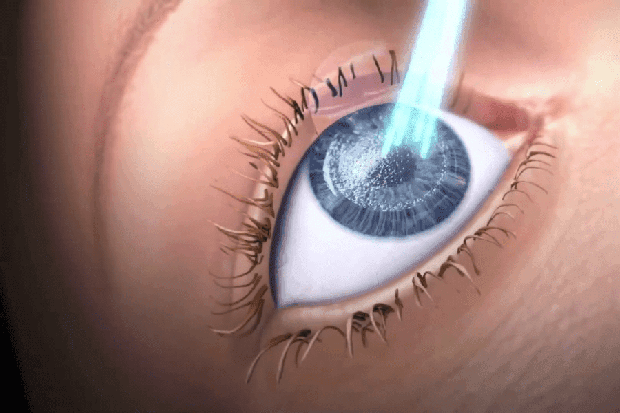 laser-eye-surgery-its-types-and-functions-the-odyssey-news